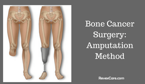 bone cancer amputation surgery method