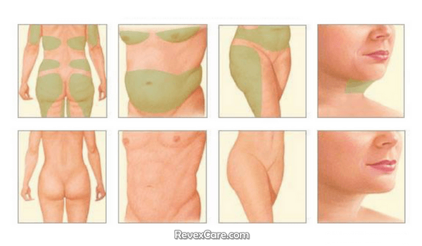 Full Body Contouring Surgery in India