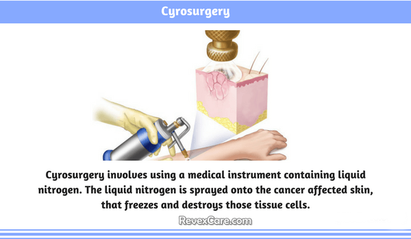 cyrosurgery