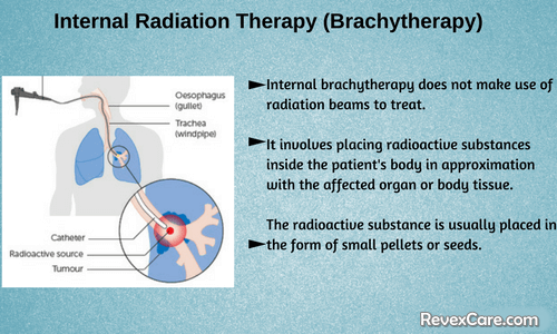 Radiation Therapy Internal