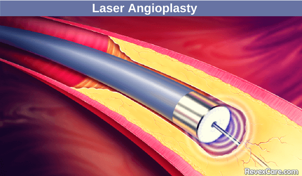 laser angioplasty