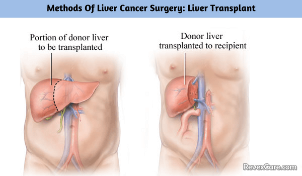 transplant of liver