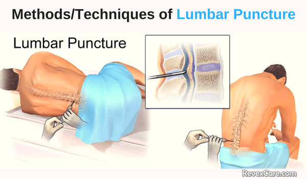 lumbar puncture procedure