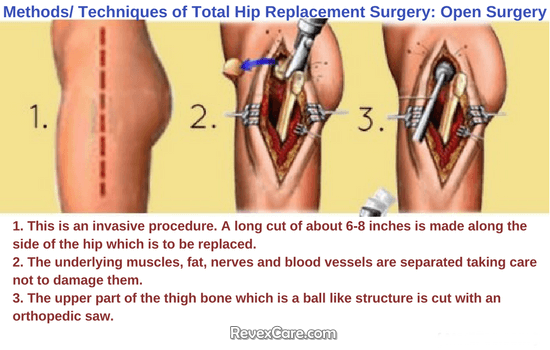 method total hip replacement