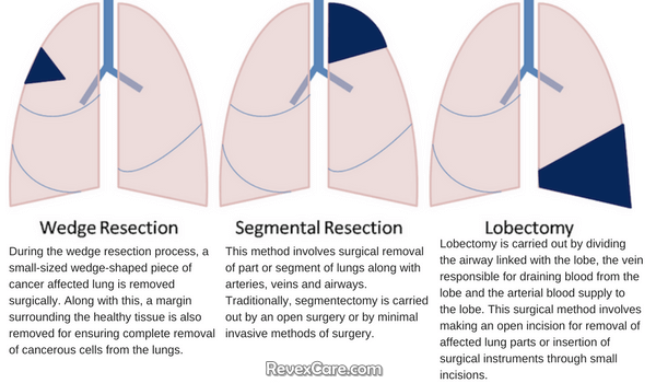 Lung Cancer Surgery Methods