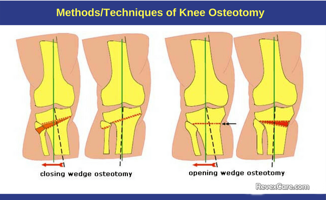 methods techniques of knee osteotomy
