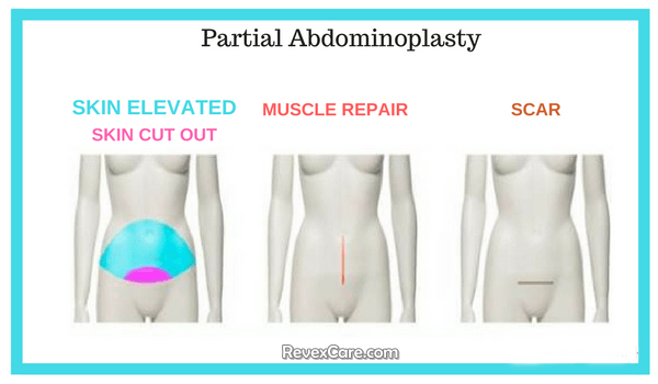 partial abdominoplasty tummy tuck surgery
