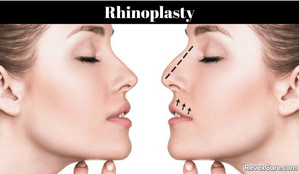 rhinoplasty cosmetic procedure to refine nose 