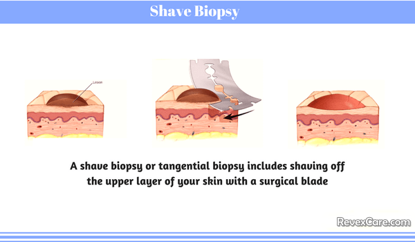 shave biopsy