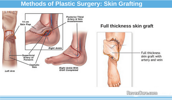 what is skin grafting method