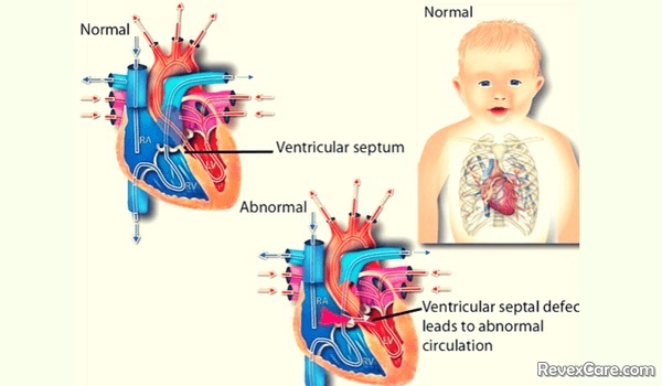 ventricular septal defect surgery