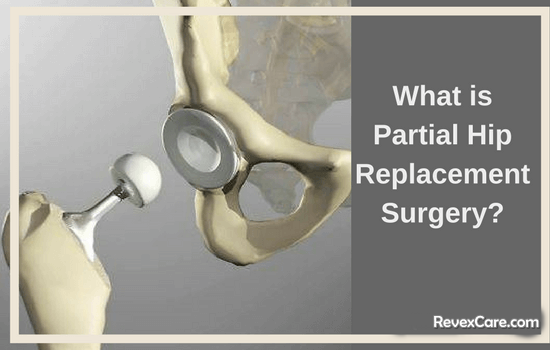 what is partial hip replacement surgery