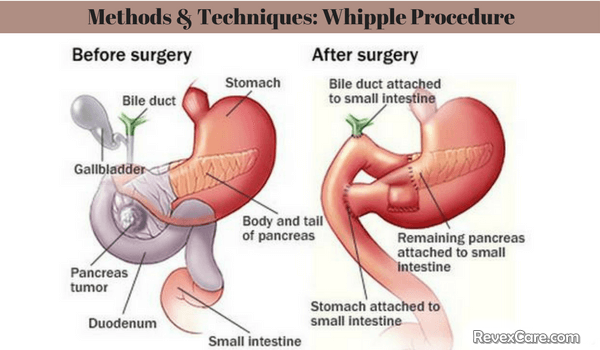 whipple procedure